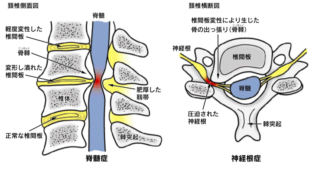 頚椎症