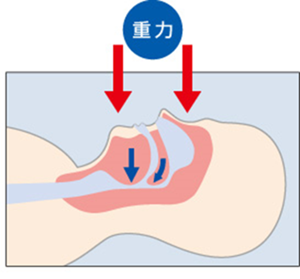 問題の勃起不全