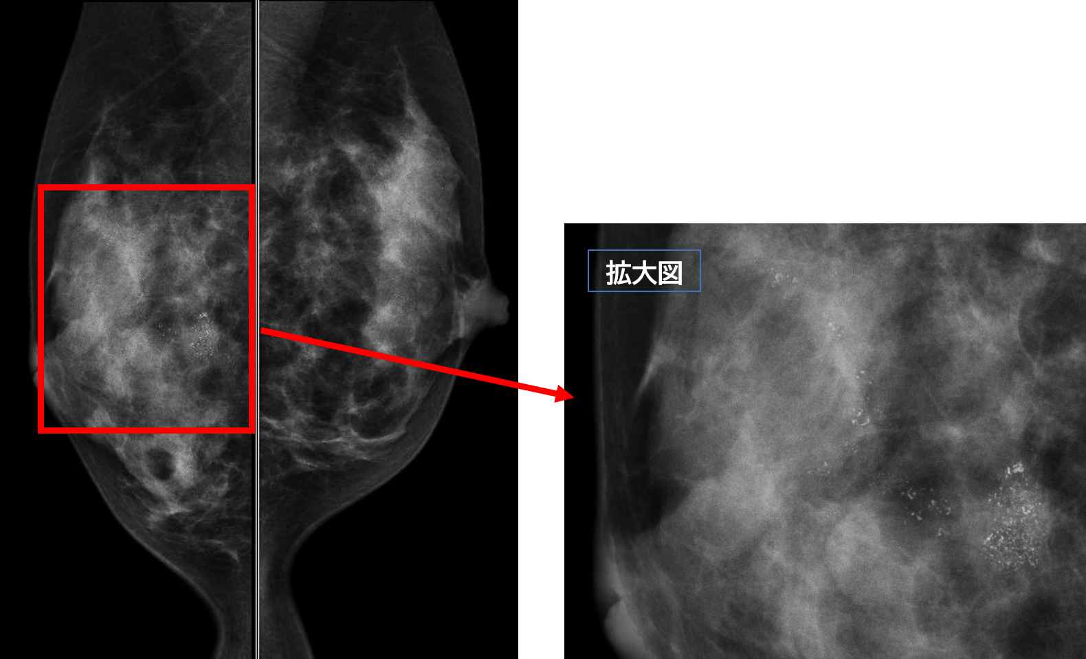 マンモグラフィに写し出される石灰化